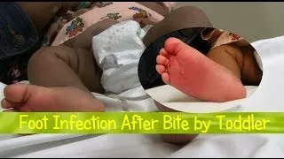 Infant Foot Cellulitis after Bite by Toddler