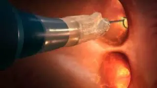 How Cryoballoon ablation works