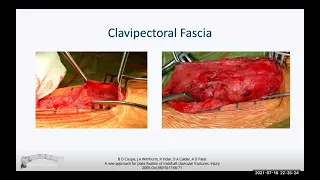 Midshaft clavicle fracture ORIF