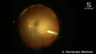 Vista intraocular inyección Ozurdex®