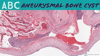 Aneurysmal Bone Cyst (ABC): 5-Minute Pathology Pearls