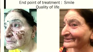 Depigmentation in Vitiligo: Combination Approach With Lasers and Medications
