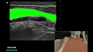 How To: QUADRATUS LUMBORUM BLOCK 3D Video