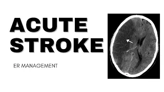 Acute Stroke || ER Management