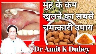 मुहं खोलने की दवा क्या है । मुहं खोलने का आयुर्वेदिक उपचार ,osmf in hindi  । osmf treatment in hindi