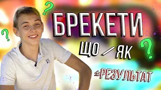 БРЕКЕТАМ КІНЕЦЬ! МІЙ ДОСВІД + РЕЗУЛЬТАТ