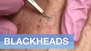 BlackHead (Chloracne) Extraction