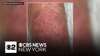 What doctors know about the new sexually transmitted form of ringworm reported in NYC