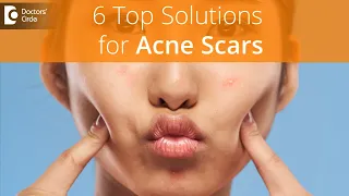 6 TIPS to remove Acne Scar | How can I remove acne scars? -Dr. Renuka Shetty| Doctors' Circle