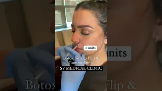 BOTOX Results: Quick, Easy Solution for Gummy Smile and Lip Flip | Skin Vitality Medical Clinic