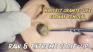 Hardest Granite-like Massive Earwax Removal- Raw & Extreme Close-up Version