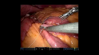 Robotic H-type Jejuno-Jejunostomy during Roux-en-Y gastric bypass for Morbid Obesity