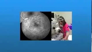 Diabetic Retinopathy  Fluorescein Angiography