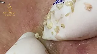 Blackheads and whiteheads (211-2) | Loan Nguyen