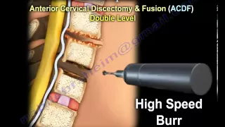 Cervical Spine ,Decompression And Fusion . - Everything You Need To Know - Dr. Nabil Ebraheim