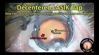 cataract surgery in an eye with a decentered LASIK flap