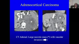 Adrenal Disorders