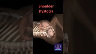 Baby Stuck During Birth | Shoulder Dystocia #shorts #pregnancy #youtubeshorts