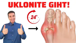 How to get rid of GOUT in 1 DAY? This will really help...