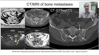 Bone metastases – One Disease with Many Signs