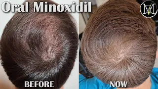 Oral Minoxidil (Loniten) Results in 10 Months