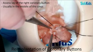 HOST - Arterial Switch Operation (Open Technique) performed on a 3D heart model - Dr David J Barron