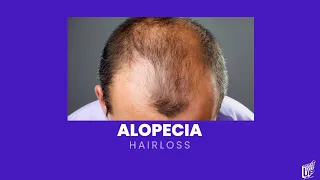 Alopecia Causes and Treatments For Men || E.4