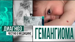 Гемангиома у детей: причины, особенности, удаление | Диагноз