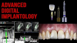 Dental Surgery - Socket shield - Connect system - Dziuba implant studio