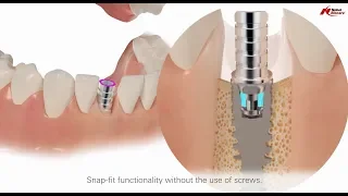 Temporary Snap Abutment - Simplify your temporization workflow