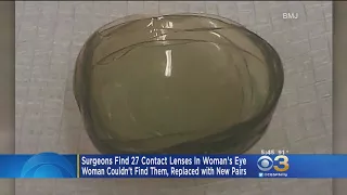 Surgeons Find 27 Contact Lenses In Woman's Eye
