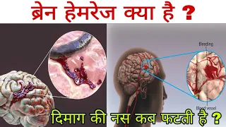 ब्रेन हेमरेज क्या है ? दिमाग की नस क्यों और कैसे फटती है ? Brain hemorrhage in hindi