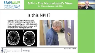 NPH Neurologists View