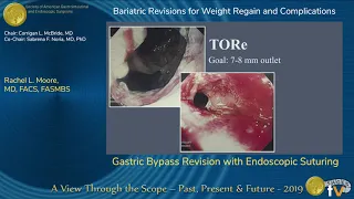 Gastric Bypass Revision with Endoscopic Suturing