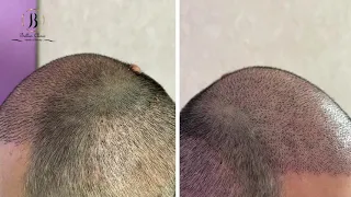 10 дней после пересадки волос