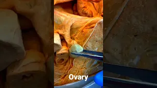 Ovary In Cadaver #health #female #viral