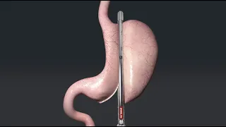 Animation of Sleeve Gastrectomy with Titan SGS™