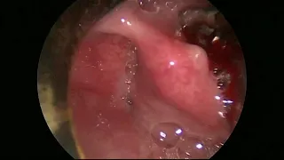 Vídeo demonstrativo de cirurgia para Papiloma de Laringe.