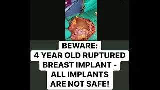 BEWARE:  4 YEAR OLD RUPTURED BREAST IMPLANT -  ALL IMPLANTS ARE NOT SAFE!