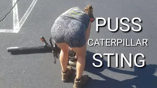 Stung By A Puss Caterpillar