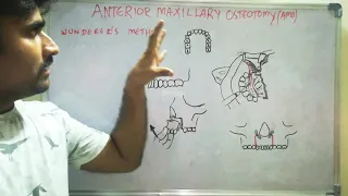 Anterior maxillary osteotomy - Wunderer's method