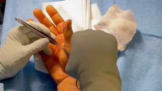 Right trigger thumb release surgery (trigger finger)