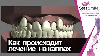 Как исправить скученность зубов? Пошаговый план перемещения зубов в элайнерах