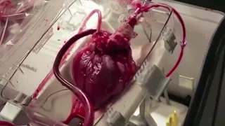 Heart beating outside of the body (Heart in Surgery)