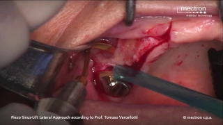 PIEZOSURGERY- CLINICAL CASE - Sinus lift with lateral approach  Prof. Tomaso Vercellotti