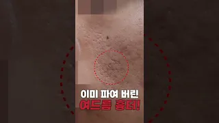 여드름 흉터 이렇게 되기전에 치료하세요! #shorts