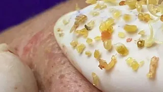 BLACKHEADS REMOVAL // LOAN NGUYEN SPA // April 6, 2021