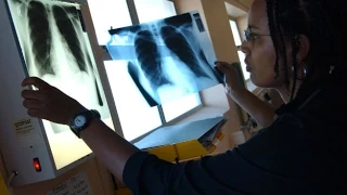 World TB Day: Unravelling the myths around tuberculosis