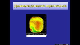 «Современные подходы к лечению кератоконуса»