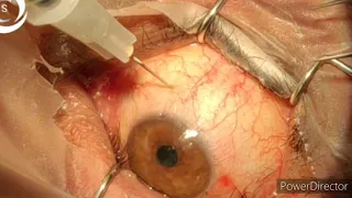 800 how to inject intravitreal to avoid endophthalmitis